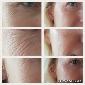 Carboxy CO2 Facial